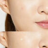 Acne Pimple Master Patch